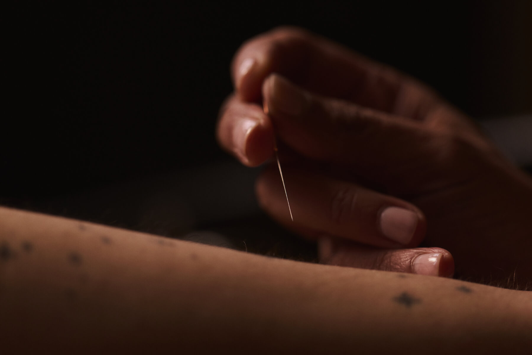 Close-up of a hand holding an acupucture needle near a forearm for acupuncture treament for anxiety.